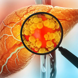 Drug-Induced Liver Injury